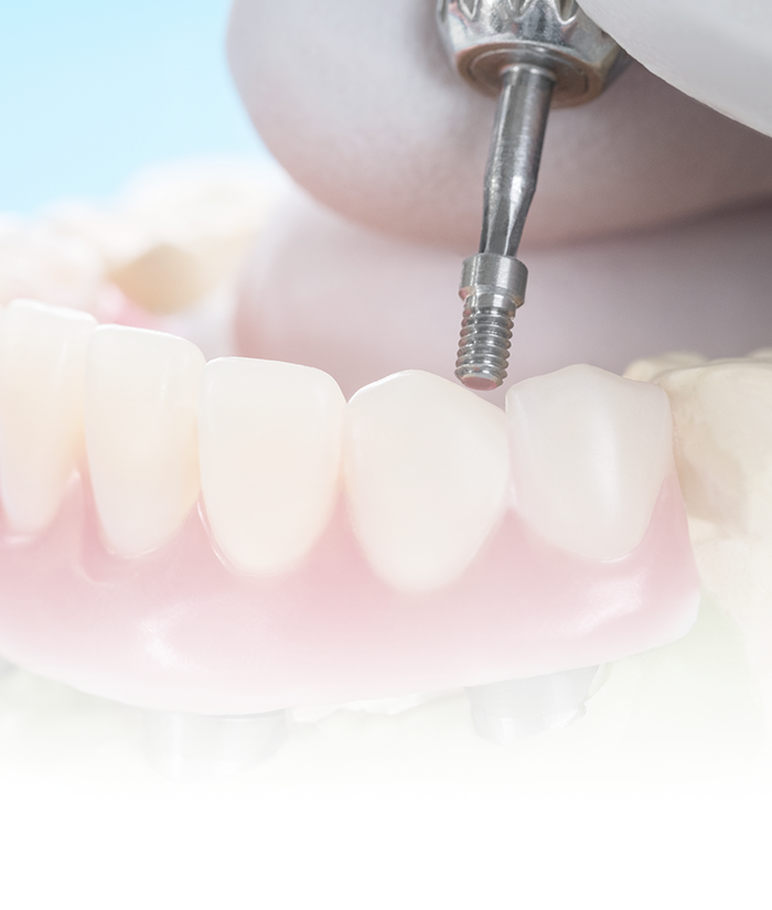Implants overdenture Dave Johnson Dental Laboratory