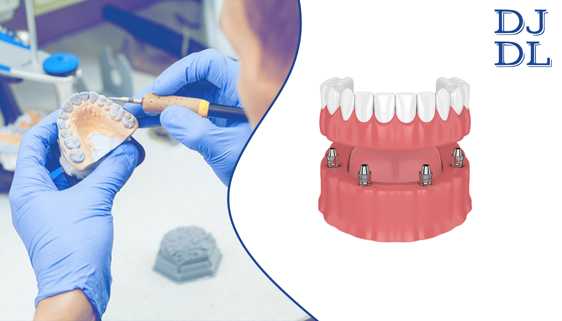 dentist-preparing-implant-supported-denture-model-for-upper-denture