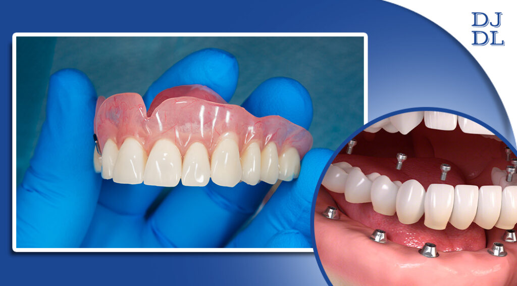 What are immediate dentures? Dave Johnson Dental Lab