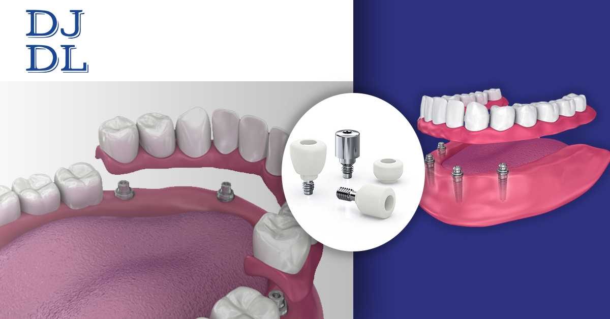 3d-render-of-dental-prosthesis-with-4-overdenture-implants-healing-abutments-and-close-up-of-4-overdenture-implants