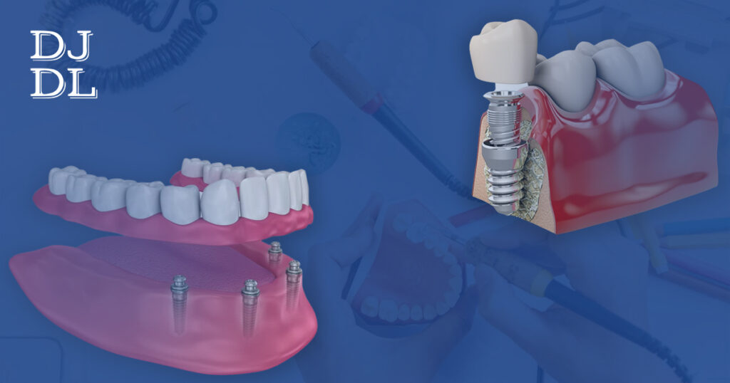 Types of Overdenture Implants Dave Johnson Dental Lab