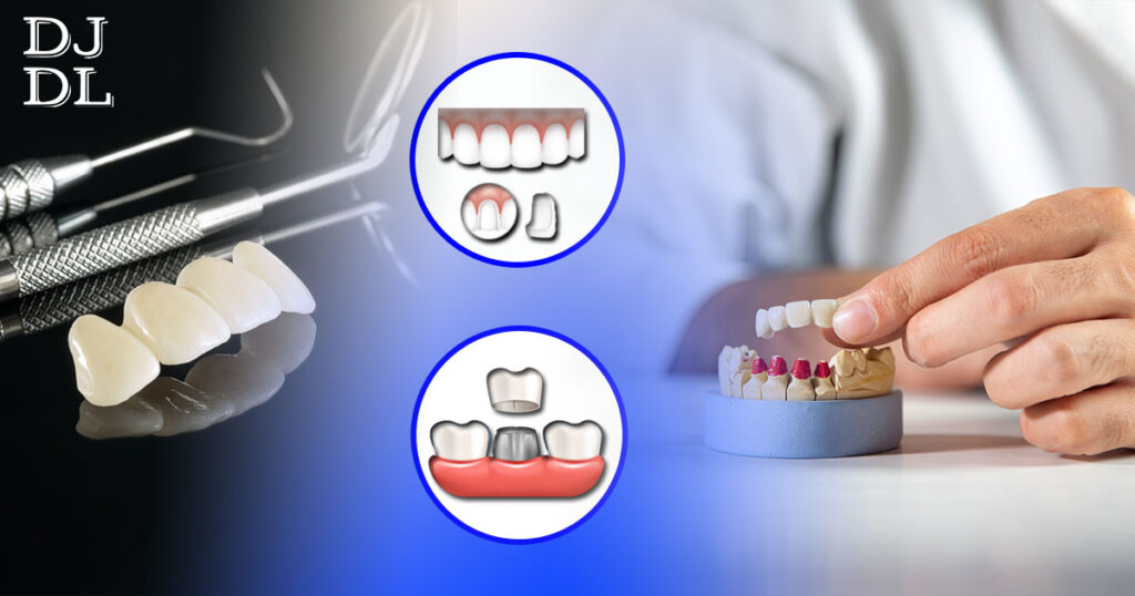 Understanding PFM Crowns | Blog | Dave Johnson Dental Lab